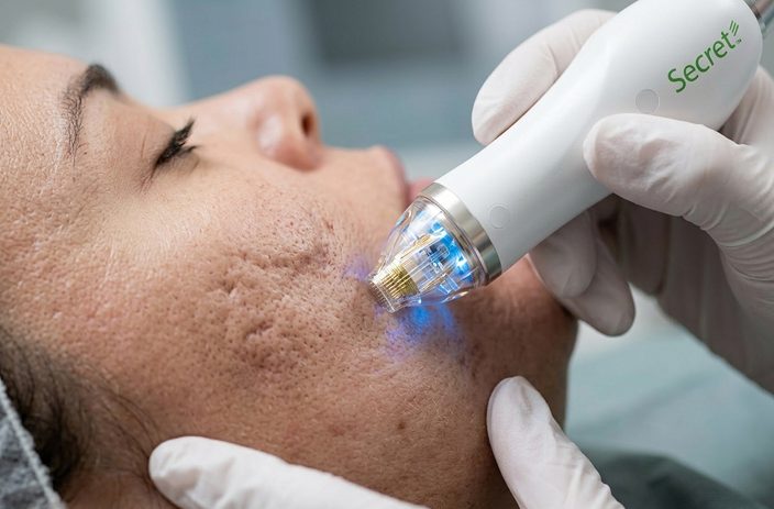 RF microneedling cutera secret pro face acne scarring 1